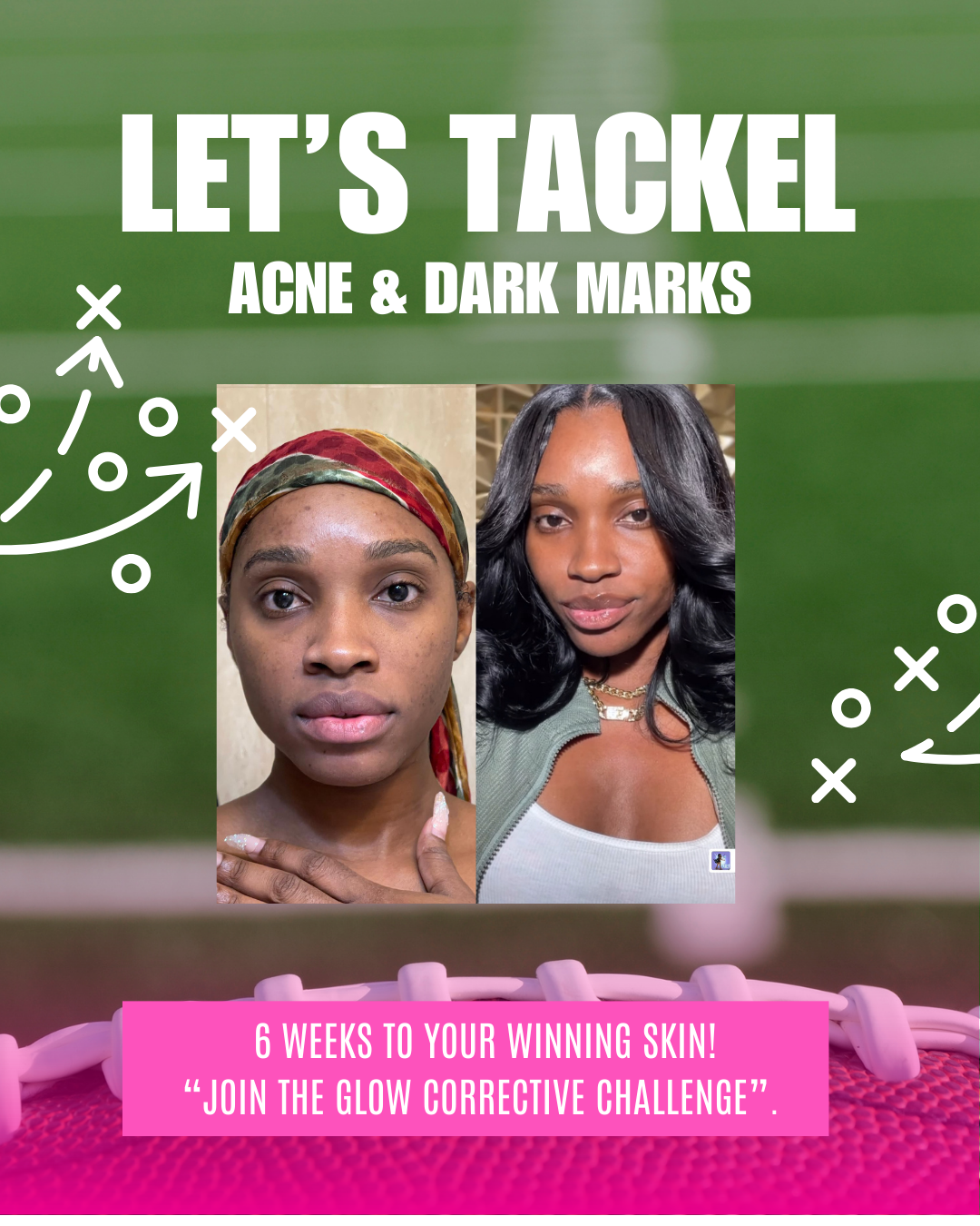 Acne and Dark Mark Play Book and Webinar