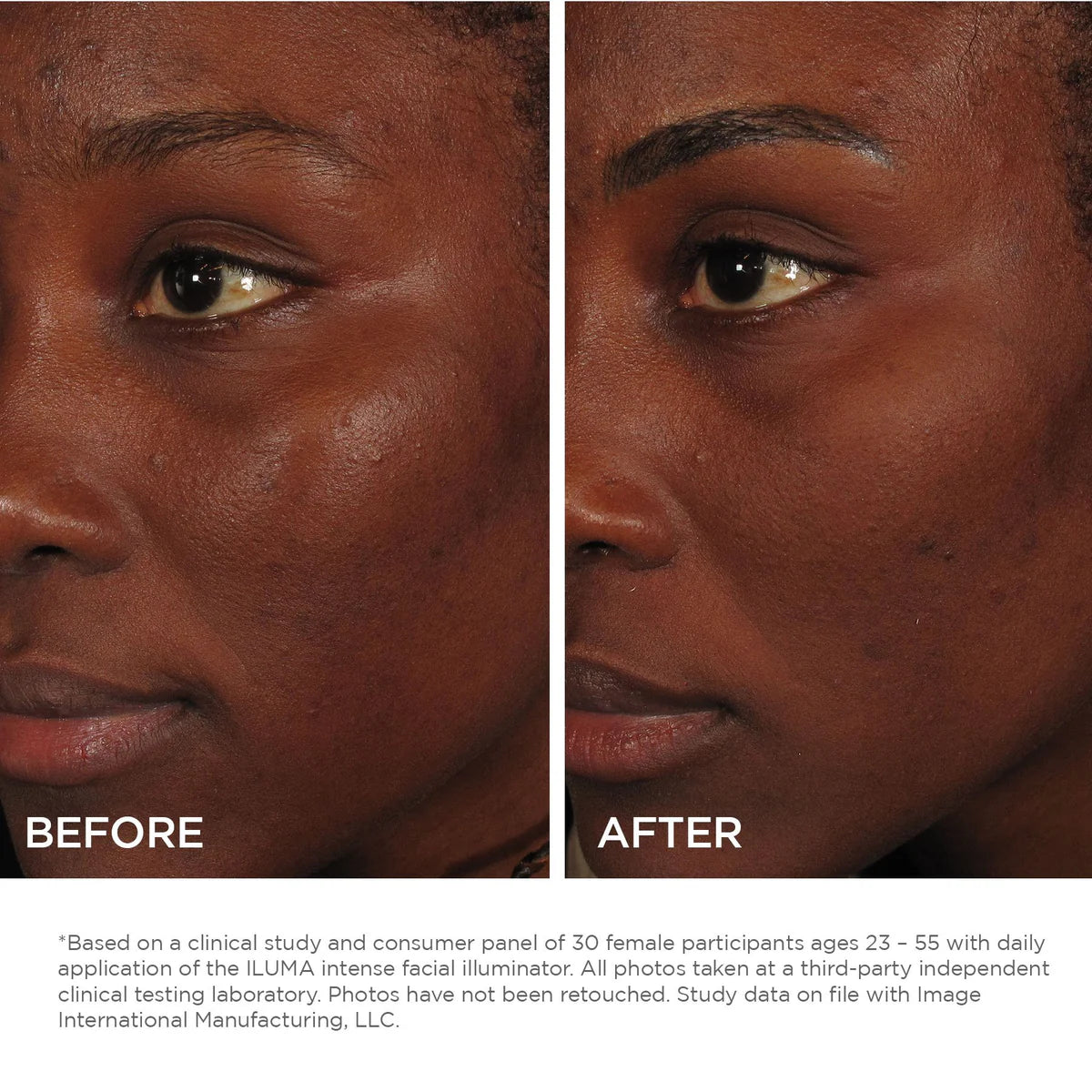 ILUMA® Intense Brightening Serum