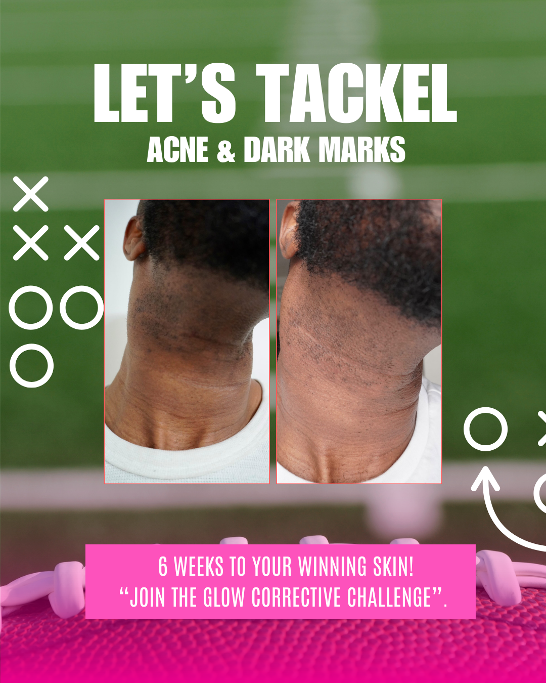 Acne and Dark Mark Play Book and Webinar